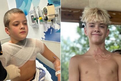 Microwaved squishy toy explodes onto boy's face and chest amid viral trend, causing horrific burns